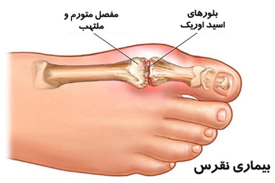 اسید اوریک,ورم و درد مفاصل,رضا کریمی