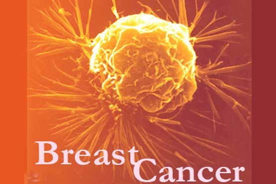ماموگرافی ,توده‌های پستان,بیماری فیبروکیستیک پستان,فیبروآدنوما,رضا کریمی,عادت ماهانه,سرطان پستان