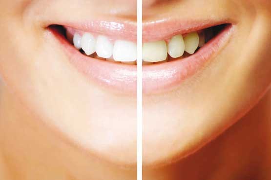 22 عادتی که باعث از بین رفتن دندان ها می شود