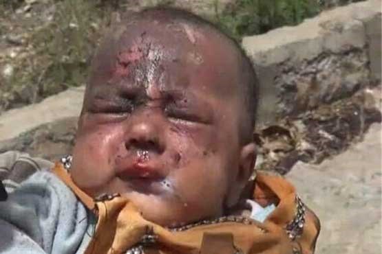 مرگ روزانه 1000 کودک یمنی