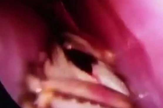خارج کردن سوسک زنده در جمجمه زن هندی +عکس اخبار هند, حوادث واقعی