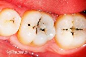 شاخص پوسیدگی دندان در خراسان شمالی نسبت به میانگین کشوری پایین‌تر است